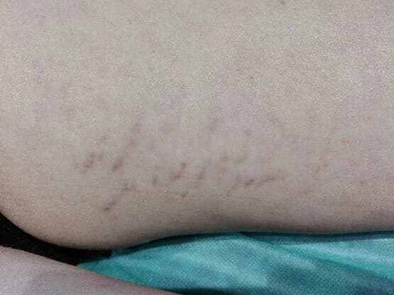 Efekty zabiegu - przed 1