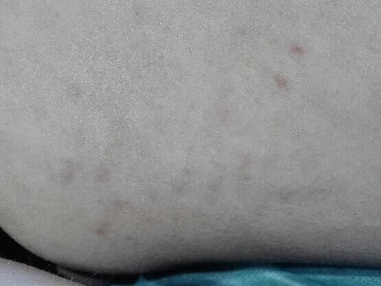 Efekty zabiegu - po 1