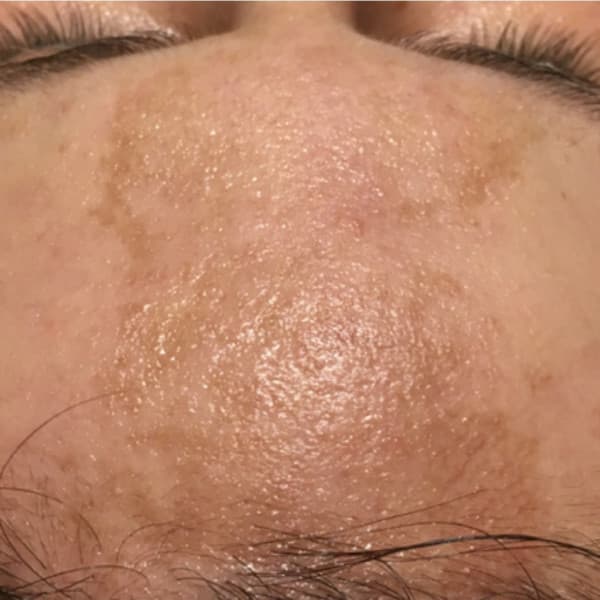 Efekty zabiegu - przed 1