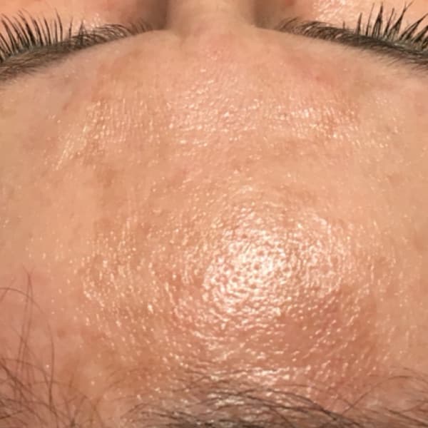 Efekty zabiegu - po 1