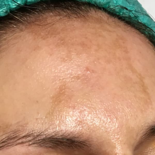 Efekty zabiegu - przed 2