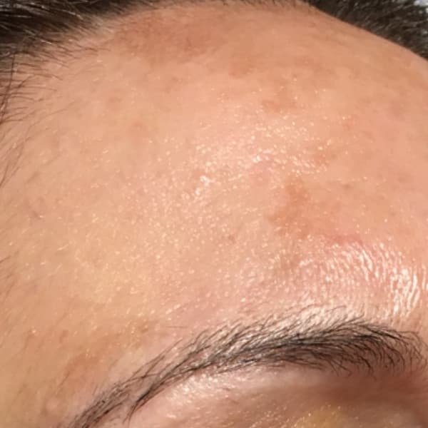 Efekty zabiegu - po 2