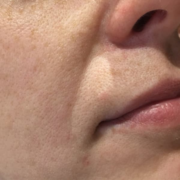 Efekty zabiegu - przed 1