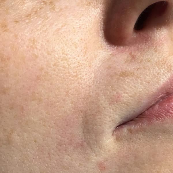 Efekty zabiegu - po 1