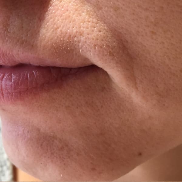 Efekty zabiegu - przed 2