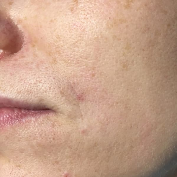 Efekty zabiegu - po 2