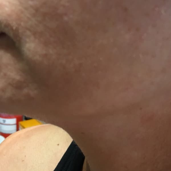 Efekty zabiegu - przed 3