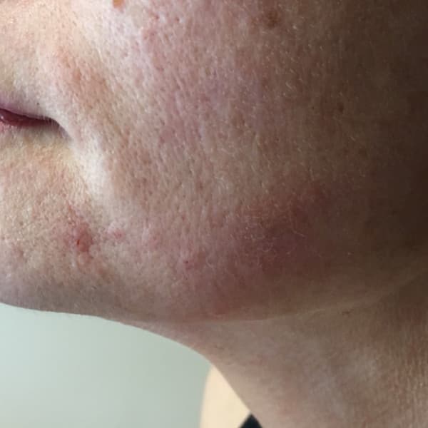 Efekty zabiegu - po 3